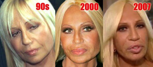 Donatella Versace avant et après chirurgie esthétique