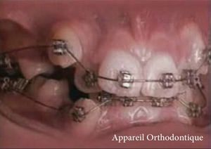 appareil-orthodontique