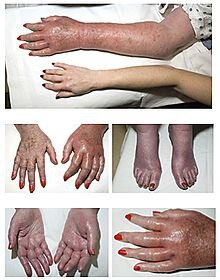 220px_Erythromelalgia