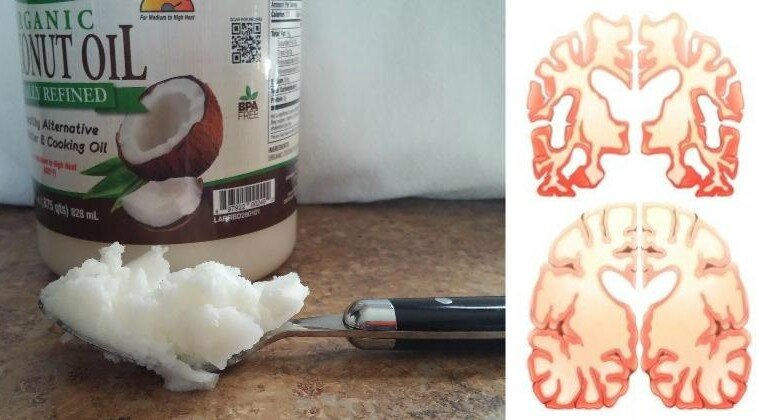 noix-de-coco-cerveau