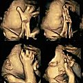 La réaction d'un fœtus dans le ventre de sa mère lorsqu'elle fume
