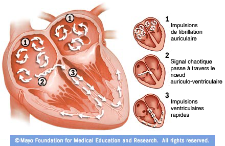 schema cardiaque fibrillation auriculaire