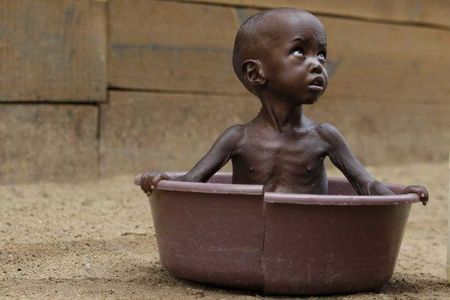 350040-taux-malnutrition-atteignent-niveaux-alarmants