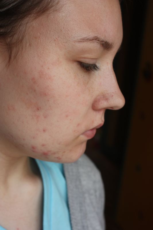 Mon traitement pour l'acné : J+15 et J+30 - Le blog beauté de Julie