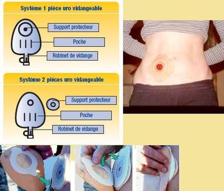 stoma