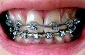 Orthodontie_Classique_Brackets_Metal