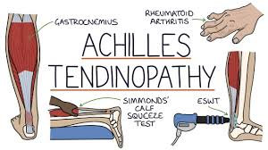 bnf tendinite achilles