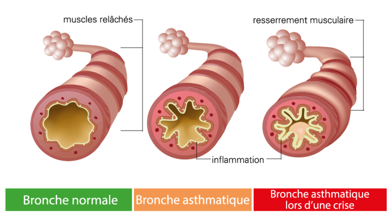 Branche asthmatique