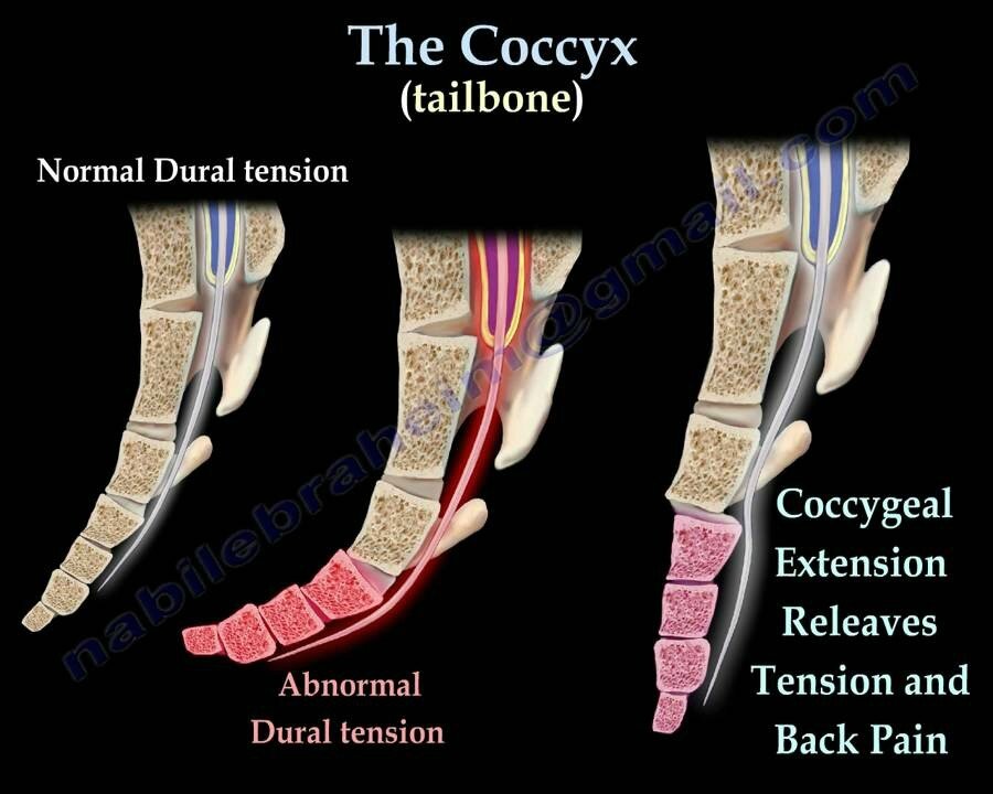 Quel coussin utiliser pour une facture du coccyx ? - inphysiofr