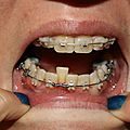 NOUVELLES DENTS POUR UNE NOUVELLE VIE (orthodontie adulte)