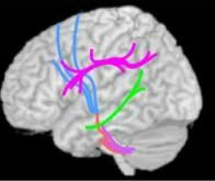 autisme_decouverte_de_nouvelles_specificites_structurelles_dans_le_cerveau