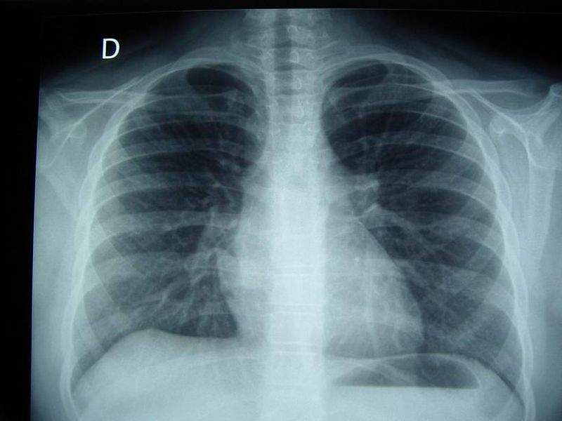 Radiographies des Poumons Non Systématiques - 