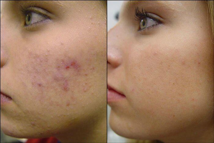 how-to-stop-acne-naturally_3_4280