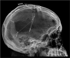 implatation_cerveau