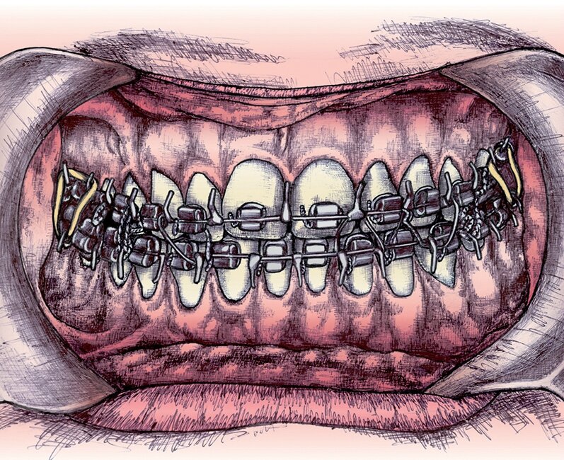 13 attache dents mandibule