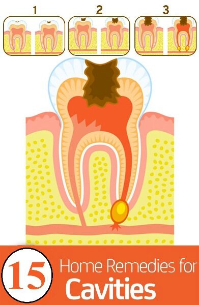 15-home-remedies-for-cavities