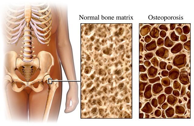 osteoporoseII