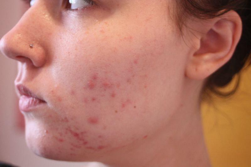Mon traitement pour l'acné : Jour J ! - Le blog beauté de Julie