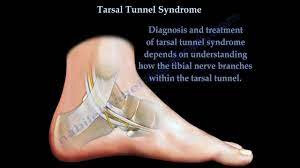Tarsal tunnel syndrome