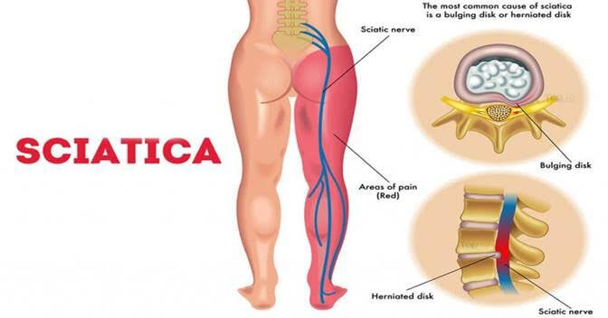 GEMMA FISHER SCIATICA