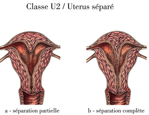 uterus separes U2