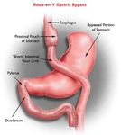 sharma_obesity_gastric_bypass_roux_en_y