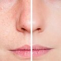 Remèdes naturels contre les cicatrices d’<b>acné</b>