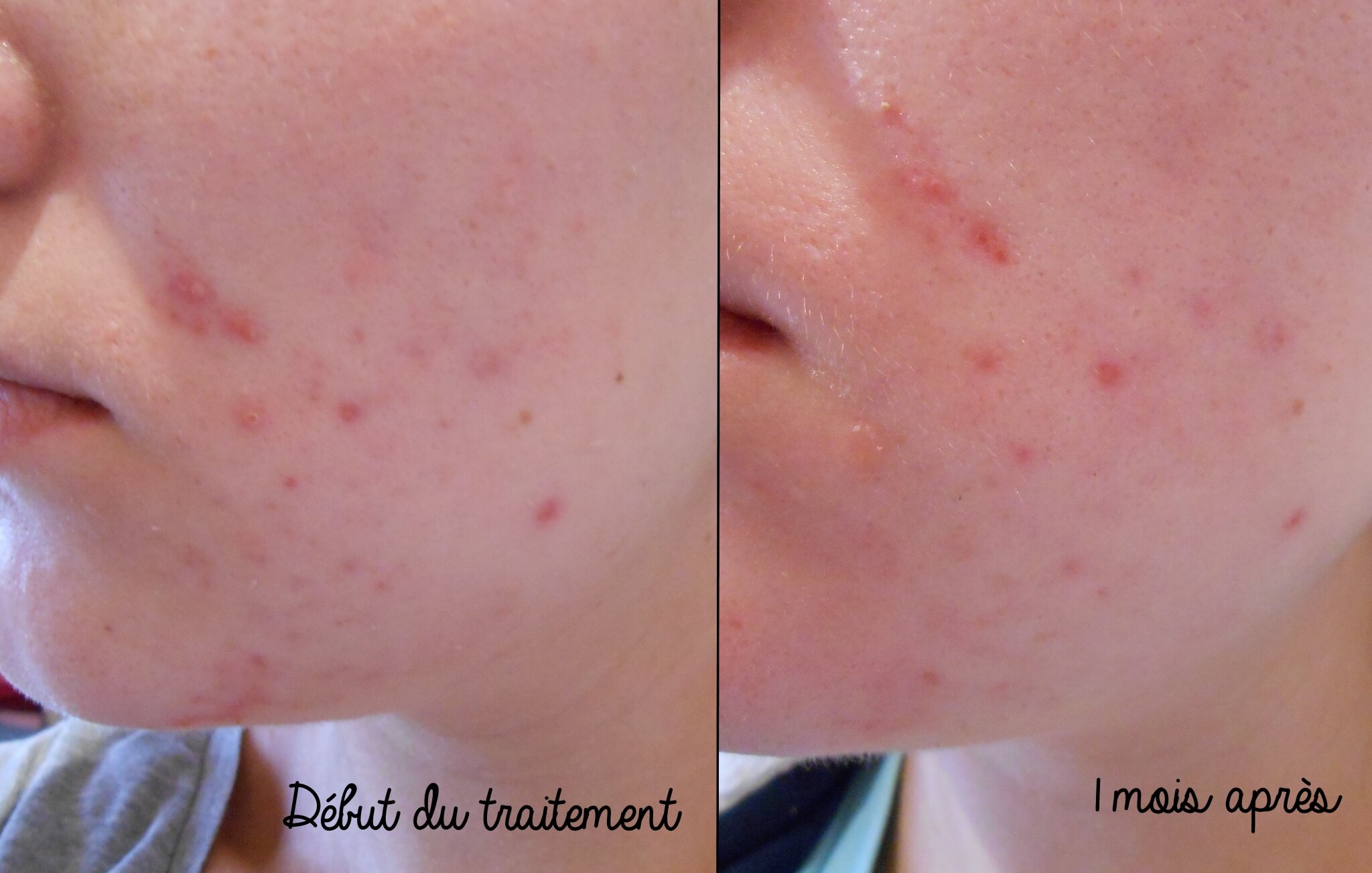 Roaccutane / Curacné - 1 mois après. - Le blog beauté de Julie