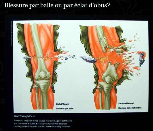 Blessure par obus