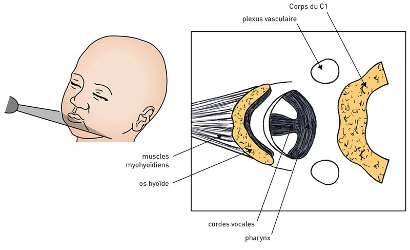 sonde tete foetus