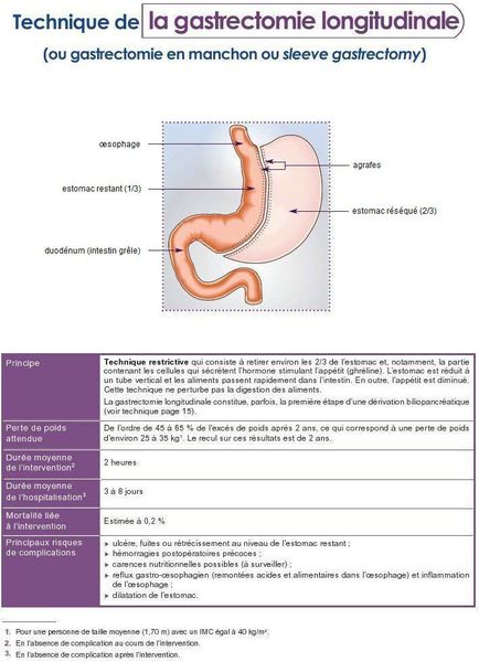 Gastrectomie-Sleeve