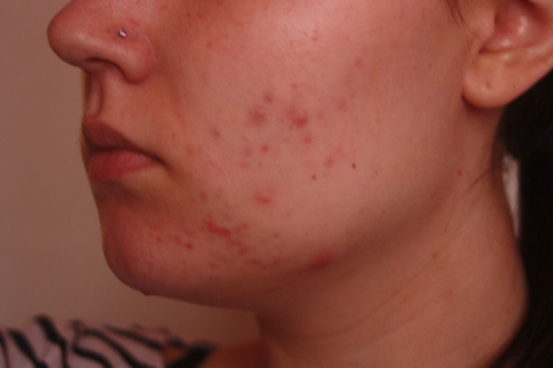 Mon traitement pour l'acné : J+15 et J+30 - Le blog beauté de Julie