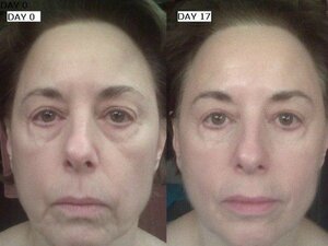 before-and-after-nu-skin-in-17-days__full