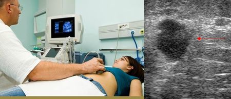Diagnostic-de-cancer-du-sein-l-echographie-plutot-que-la-mammographie-avant-40-ans_large_apimobile