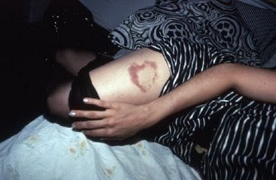 7-nan-goldin-heart-shaped-bruise_large