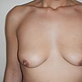 mon augmentation+lifting mammaire