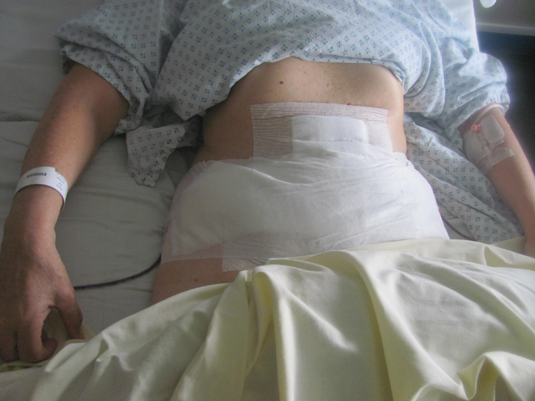 Post-opératoire 16 mois - Compte-rendu de mon Abdominoplastie