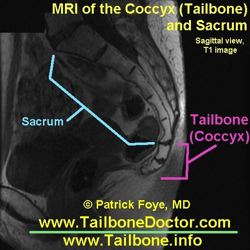 512_Tailbone_MRI_coccyx_pain_Foye
