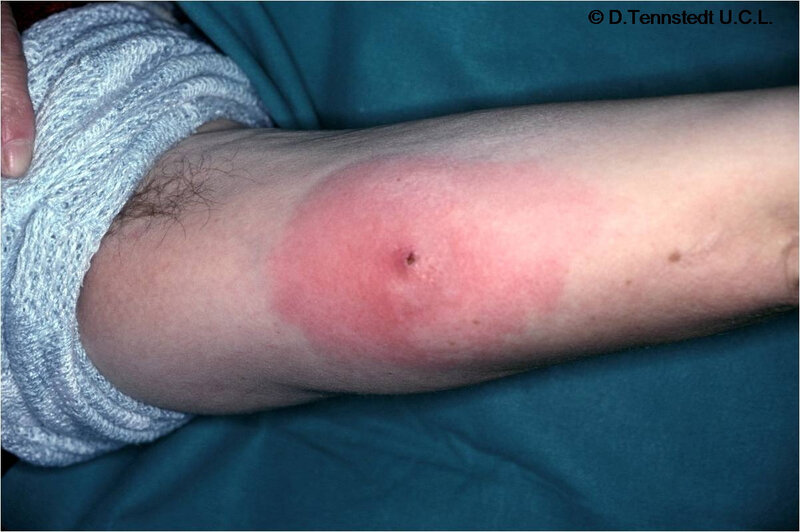 Lyme2